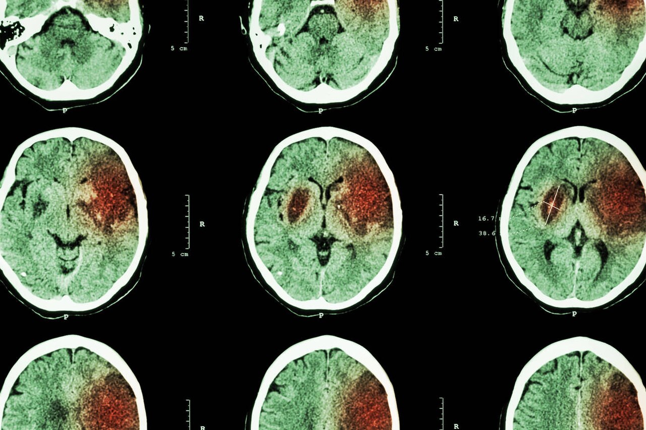 CT brain imaging used for rapid diagnosis of ischemic and hemorrhagic stroke.